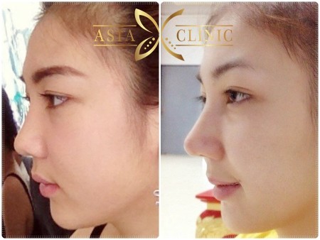 A very common cosmetic surgery in Thailand. Nose bridge surgery before and after.